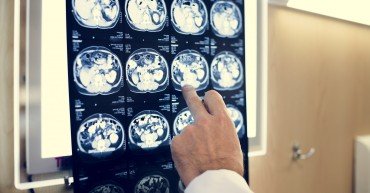 Brain CT scan x-ray film